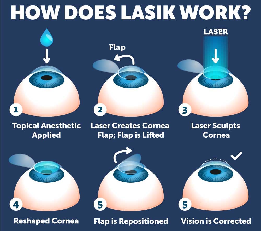 7 Stages Of Lasik Healing Timeline