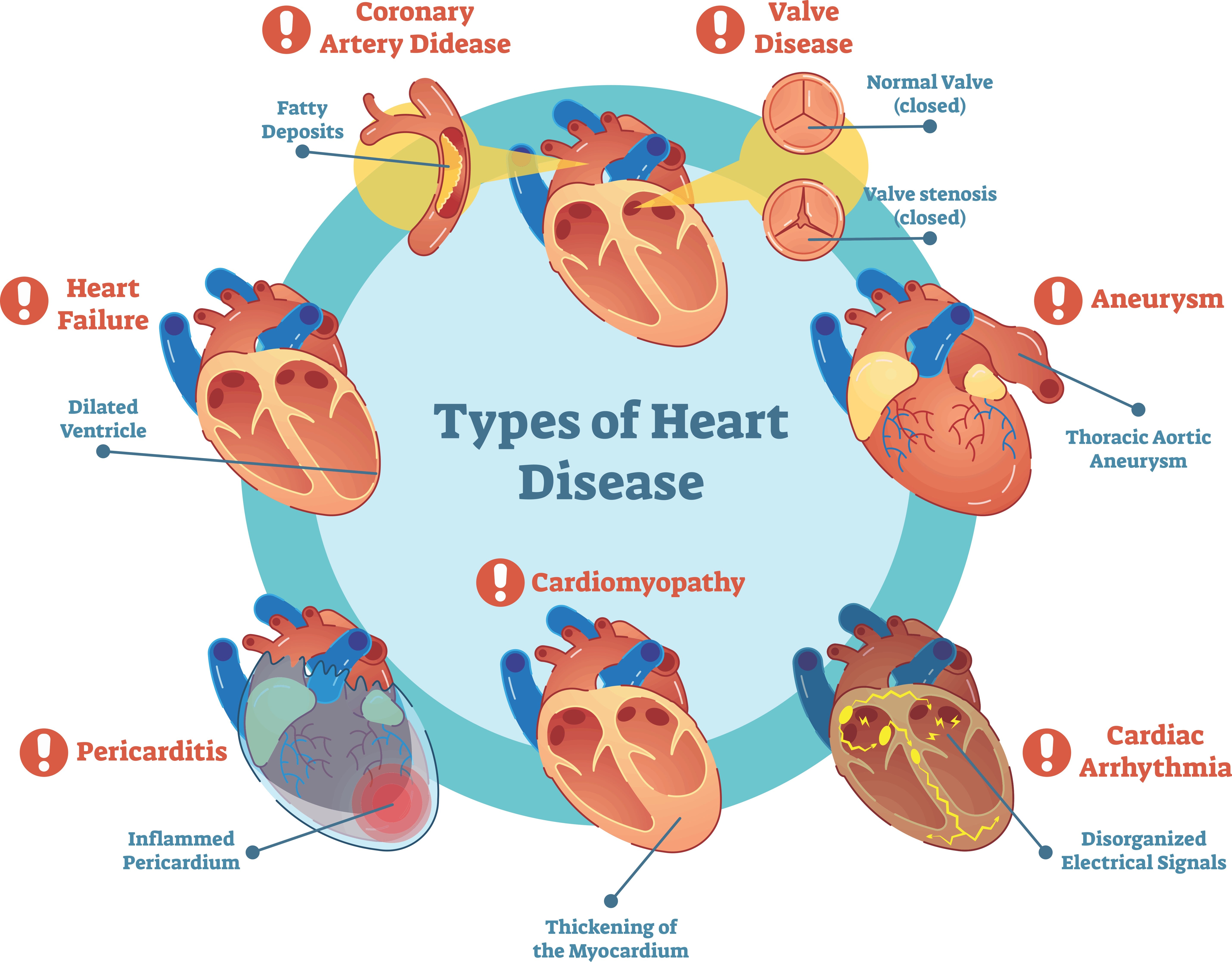 Cardiovascular Disease and Stroke