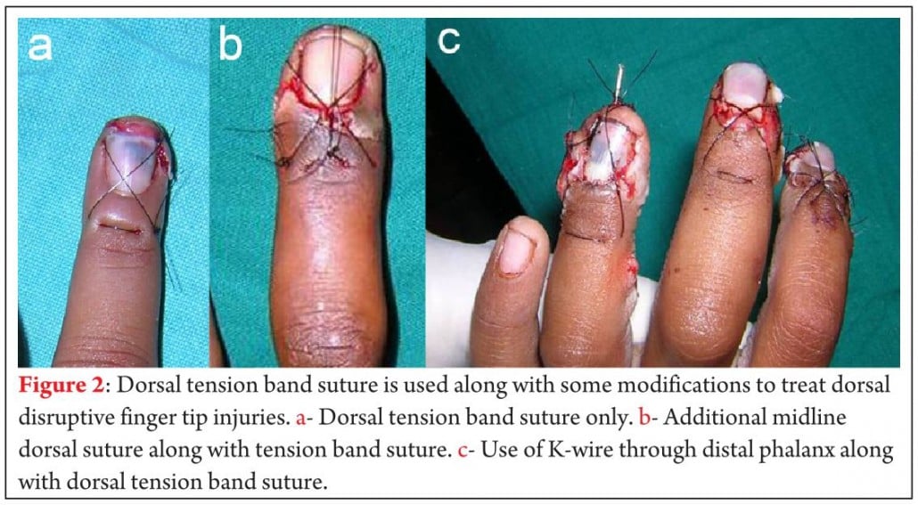 Finger Nail Bed Method