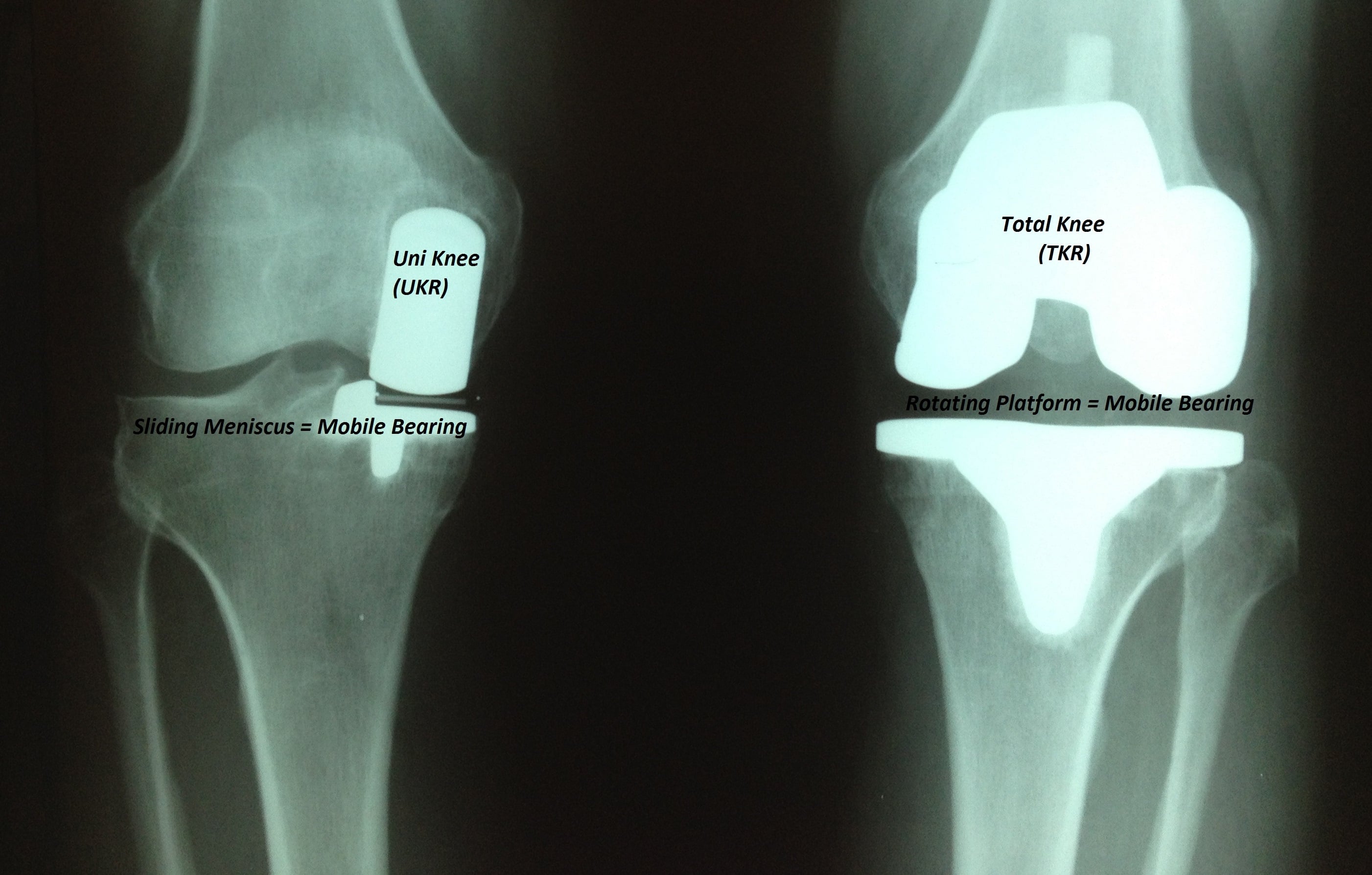 Knee Replacement Recovery Time