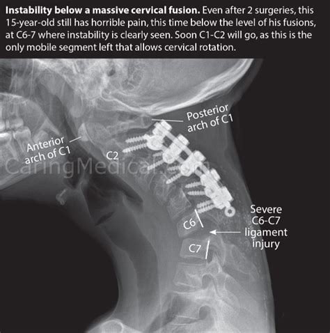 C5-C6-C7 Neck Surgery Recovery